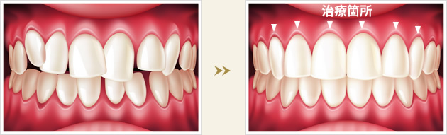 セラミック矯正の歯並び改善症例