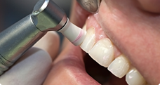 虫歯と歯周病の予防